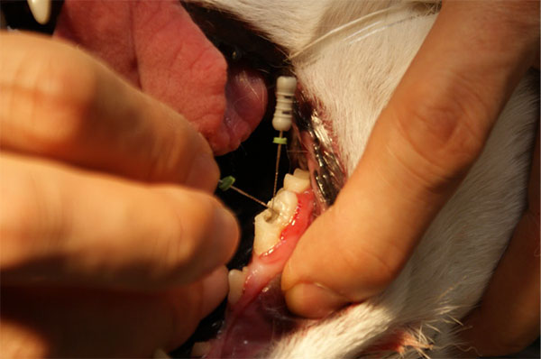 歯牙の破折による外歯瘻